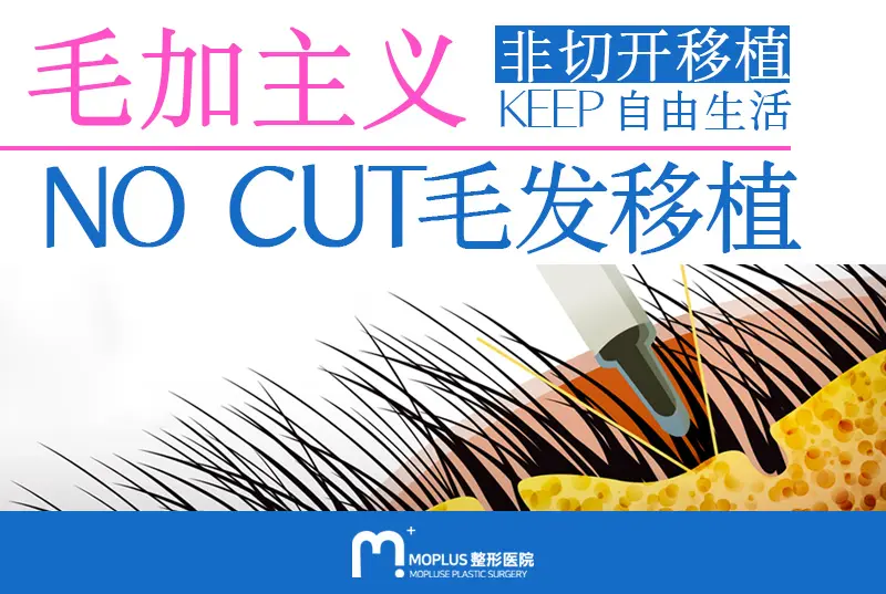 【毛发移植/植发】非切开移植KEEP 自由生活