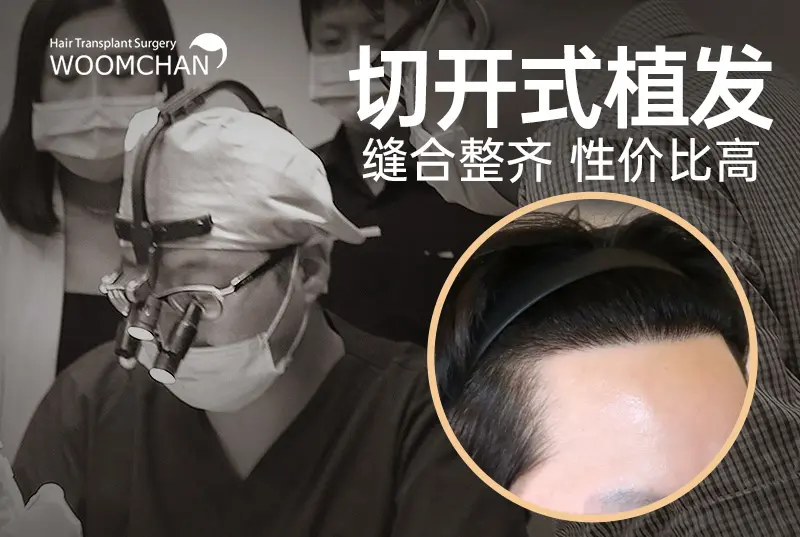 【切开式植发】缝合整齐 性价比高