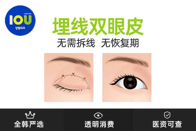 【埋线双眼皮】 无需拆线 无恢复期