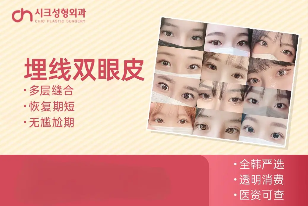 【埋线双眼皮】多层缝合 恢复期短 无尴尬期