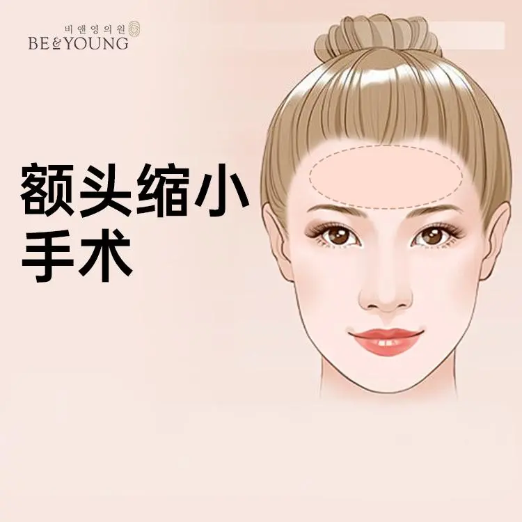 【额头缩小手术】理想比例 平衡美感