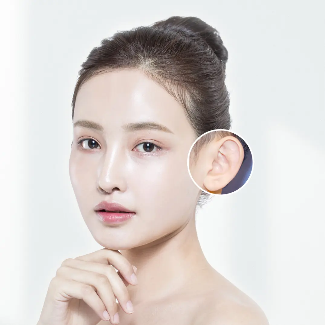 Protruding ear correction
