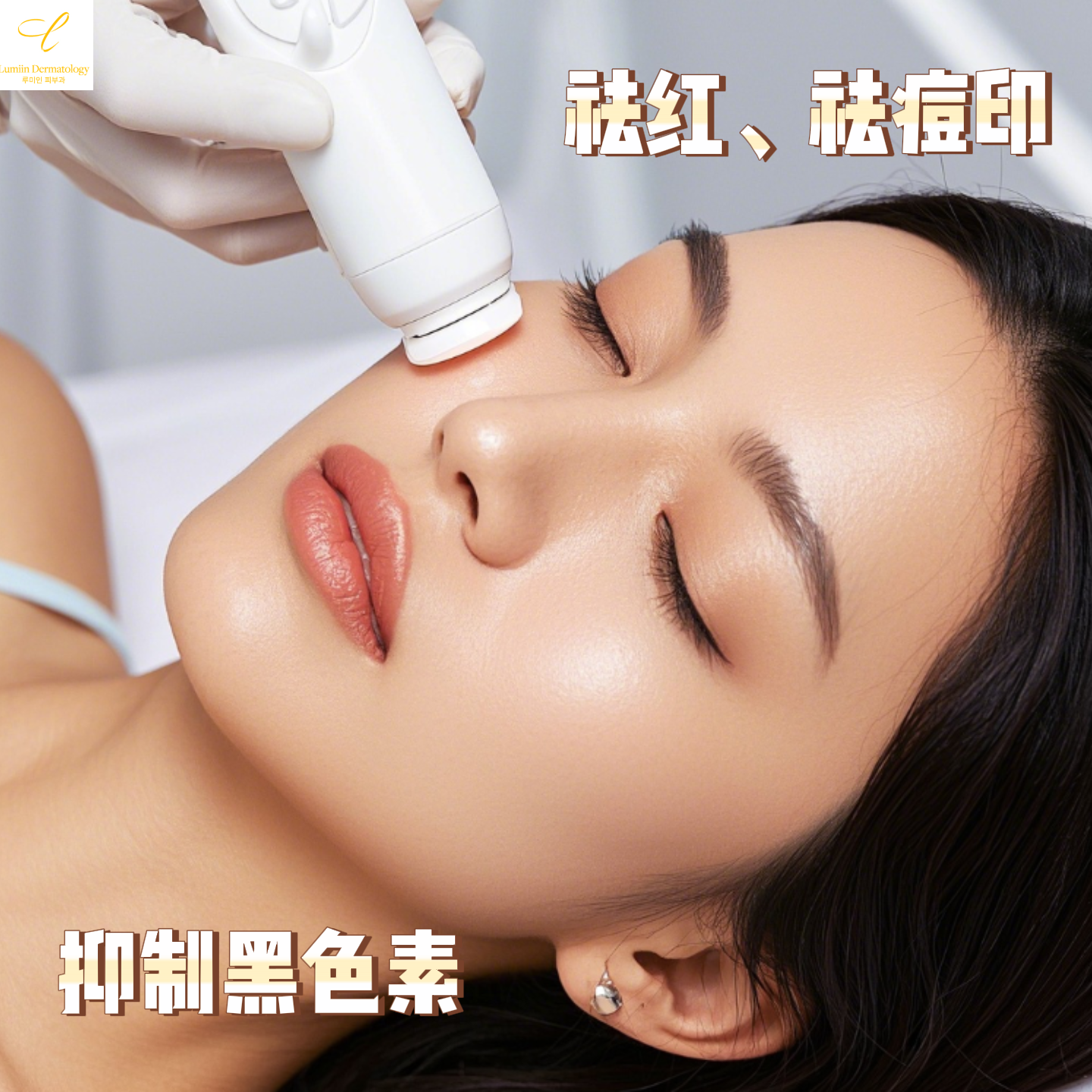 Vbeam红血丝激光/皮秒美白（二选一）