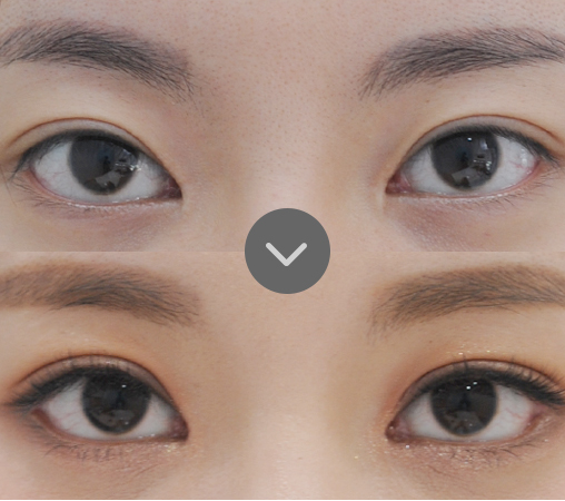 眼角修复