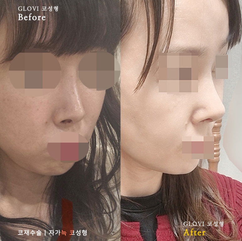 歌柔飛整形外科醫院 案例