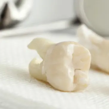 complex tooth extraction