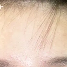 Forehead scar repair