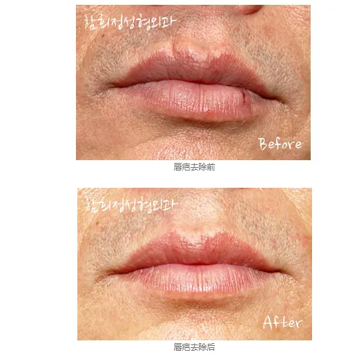 Removal of lip scars