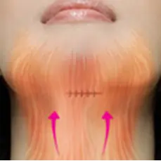 Neck lift rejuvenation