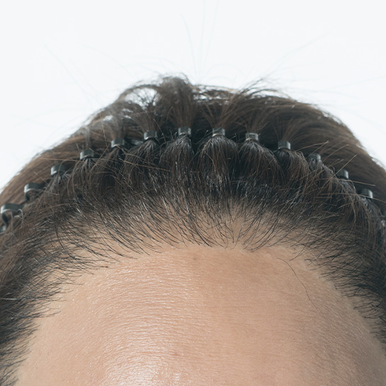 发际线_1000毛囊