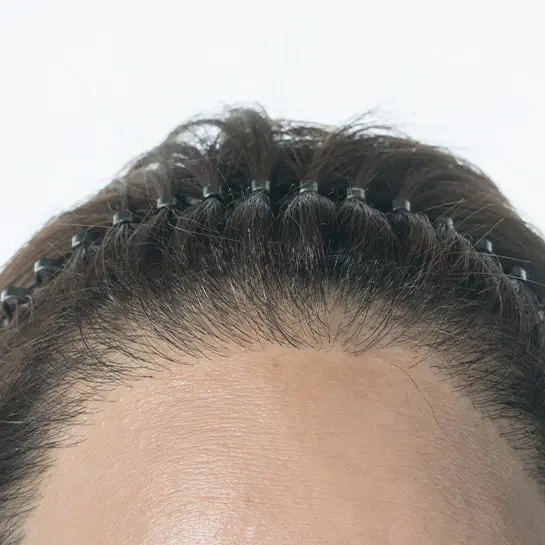 发际线不平衡种植