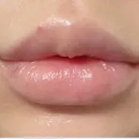 丰唇玻尿酸