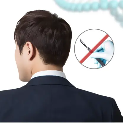 毛发移植