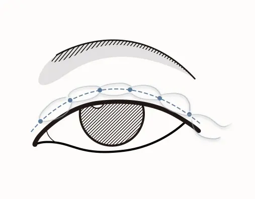 Non-incisional double eyelid
