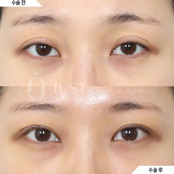 Double eyelid revision