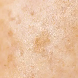 去除色斑