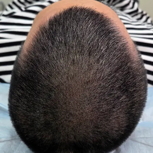 男士M型发际线