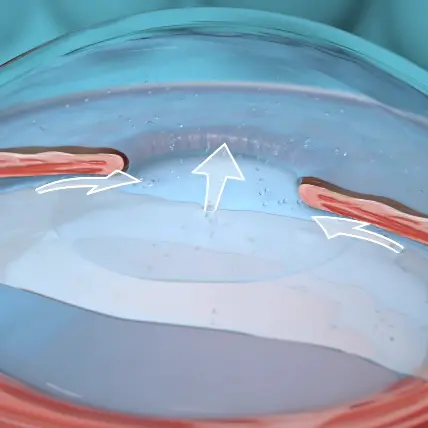 Implantable Contact Lens (ICL) Surgery