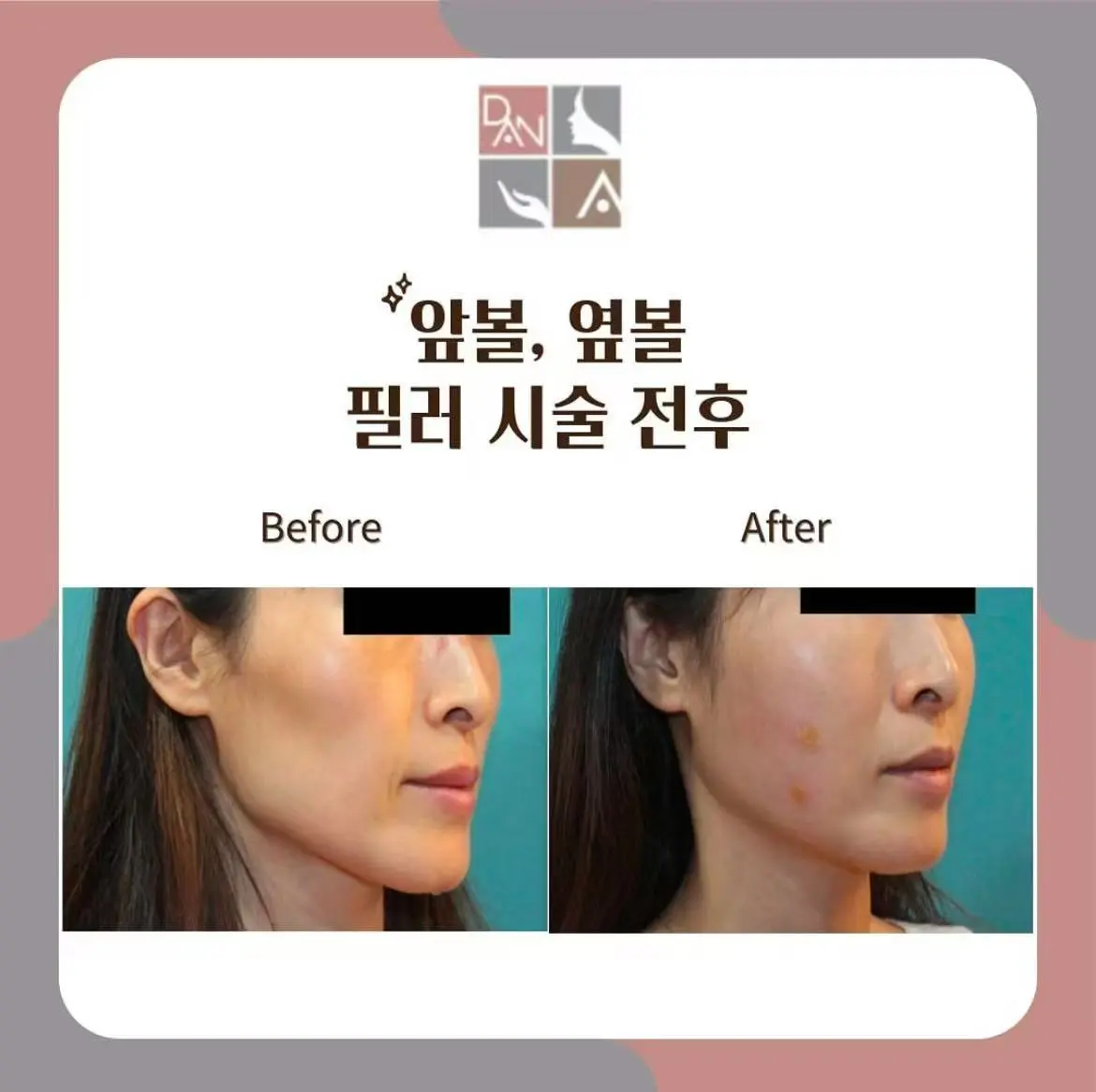 Sebaceous Gland Ablation (SGA)