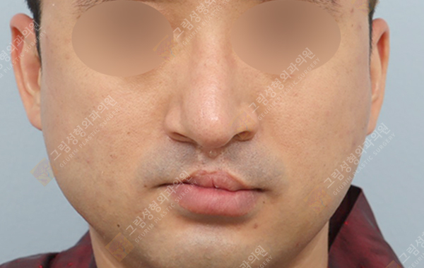 Geurim Plastic Surgery 案例