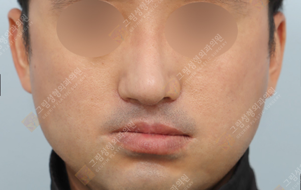 Geurim Plastic Surgery 案例