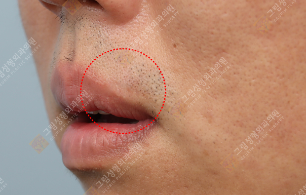 Geurim Plastic Surgery 案例