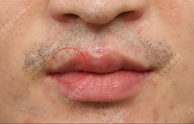 Geurim Plastic Surgery 案例
