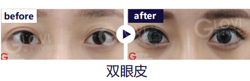 歌柔飛整形外科醫院 案例