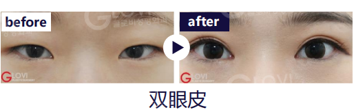 歌柔飛整形外科醫院 案例