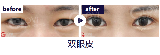 歌柔飛整形外科醫院 案例