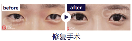 歌柔飛整形外科醫院 案例