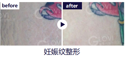 歌柔飛整形外科醫院 案例