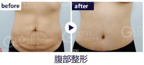 歌柔飛整形外科醫院 案例
