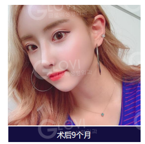 歌柔飛整形外科醫院 案例