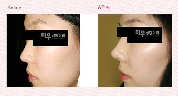 Jeju Miwoo Plastic Surgery 案例