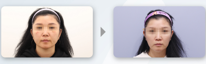 Cheongdam Bom-on Dermatology Clinic 案例