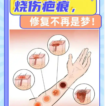 儿童烧伤治疗