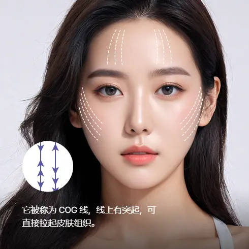 线雕提升