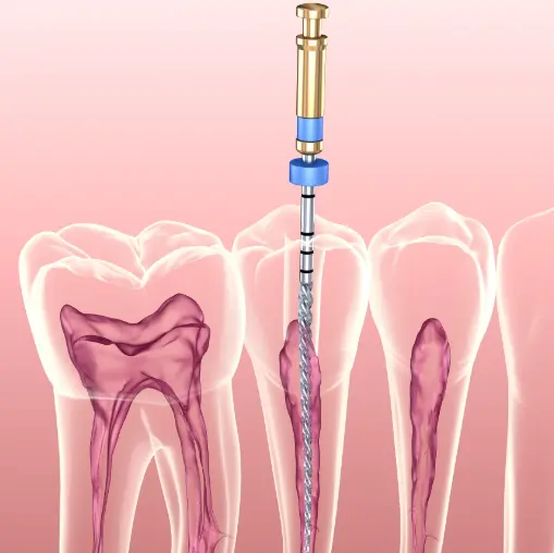 Root canal treatment for 3 teeth