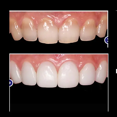 Regular dental veneer