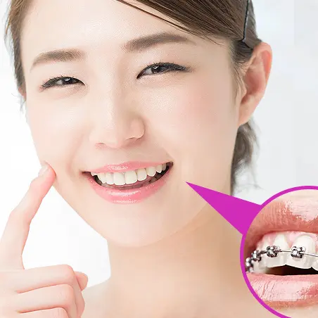 Teeth alignment