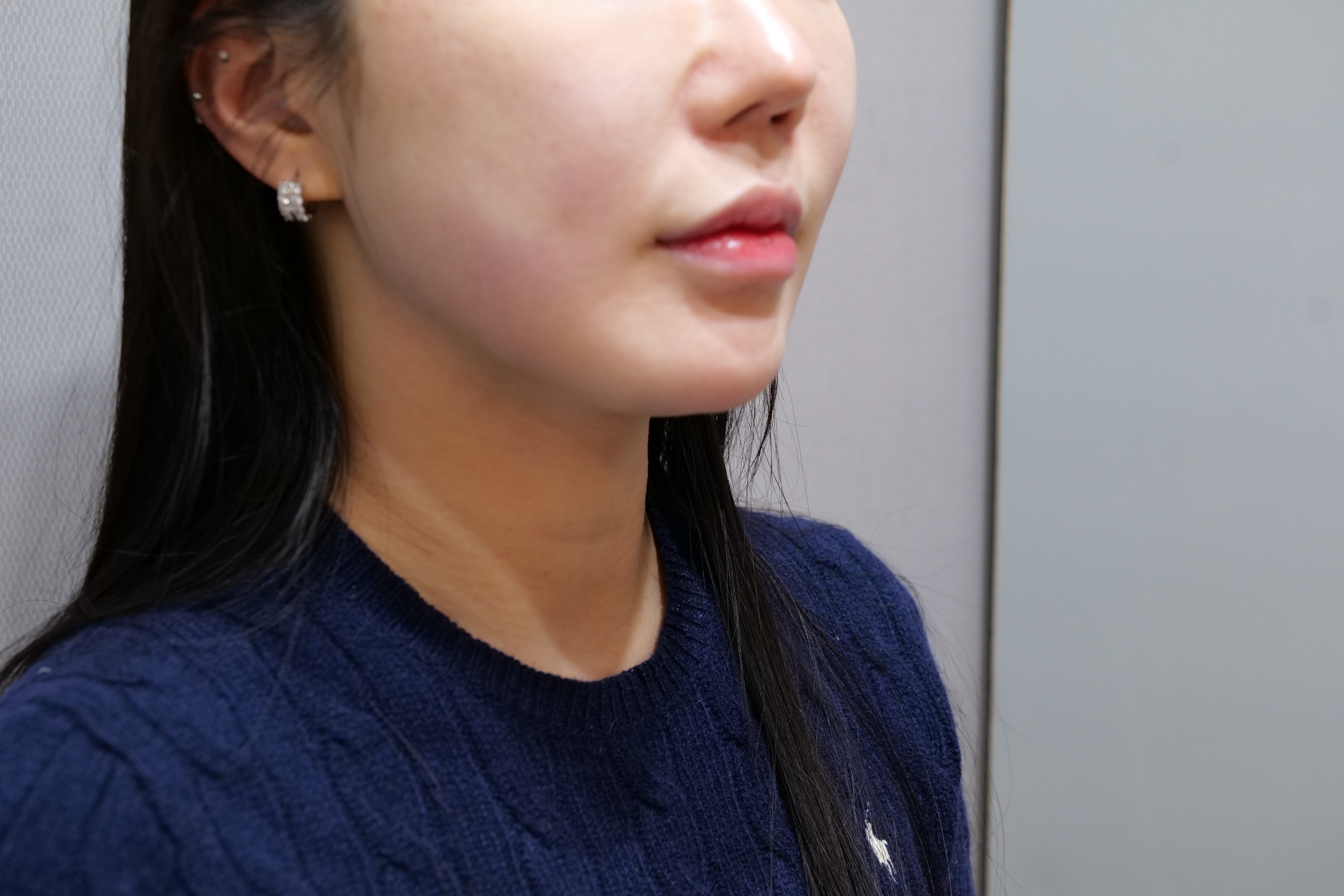 JRYN釜山皮膚科 案例