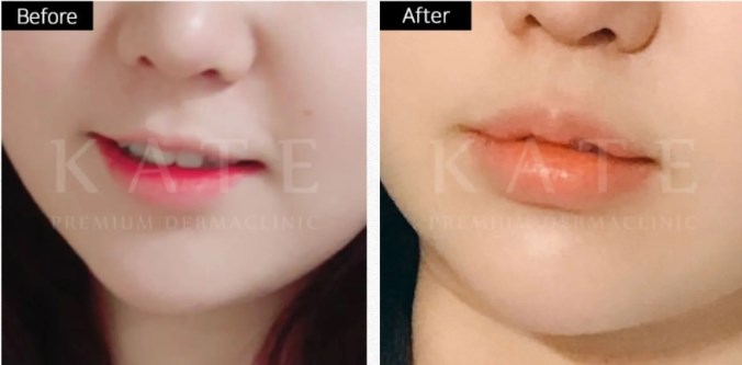 Kate premium derma clinic 案例