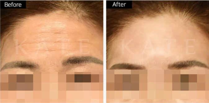 Kate premium derma clinic 案例