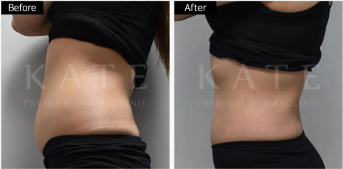Kate premium derma clinic 案例