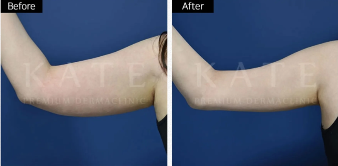 Kate premium derma clinic 案例