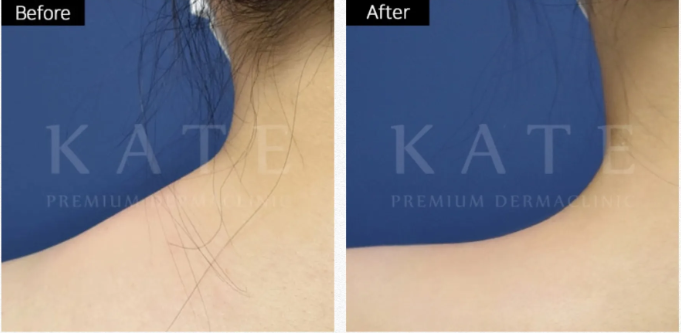 Kate premium derma clinic 案例