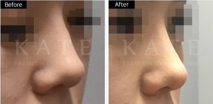 Kate premium derma clinic 案例