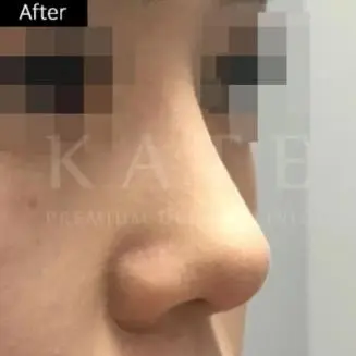 Nasal bridge thread embedding