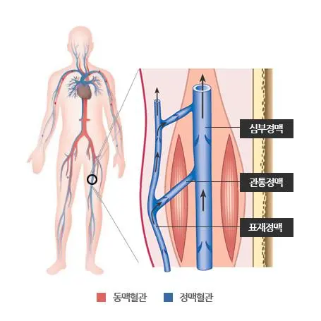 Treatment of lower extremity venous malformations